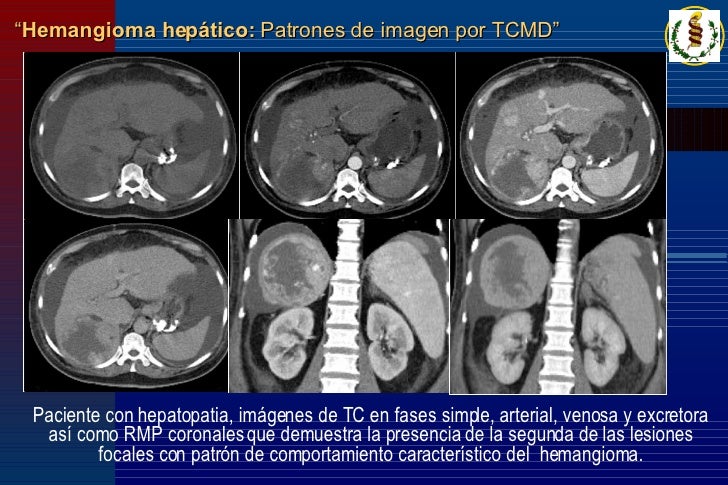 hemangioma hepatico